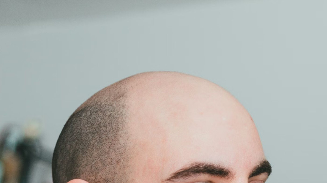 Tıp tarihinde dönüm noktası: Erkek tipi kellik için ilaç bulundu