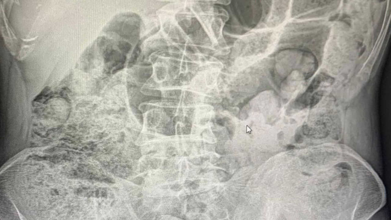 Siirt'te midelerinden uyuşturucu çıkan 4 şahıs tutuklandı