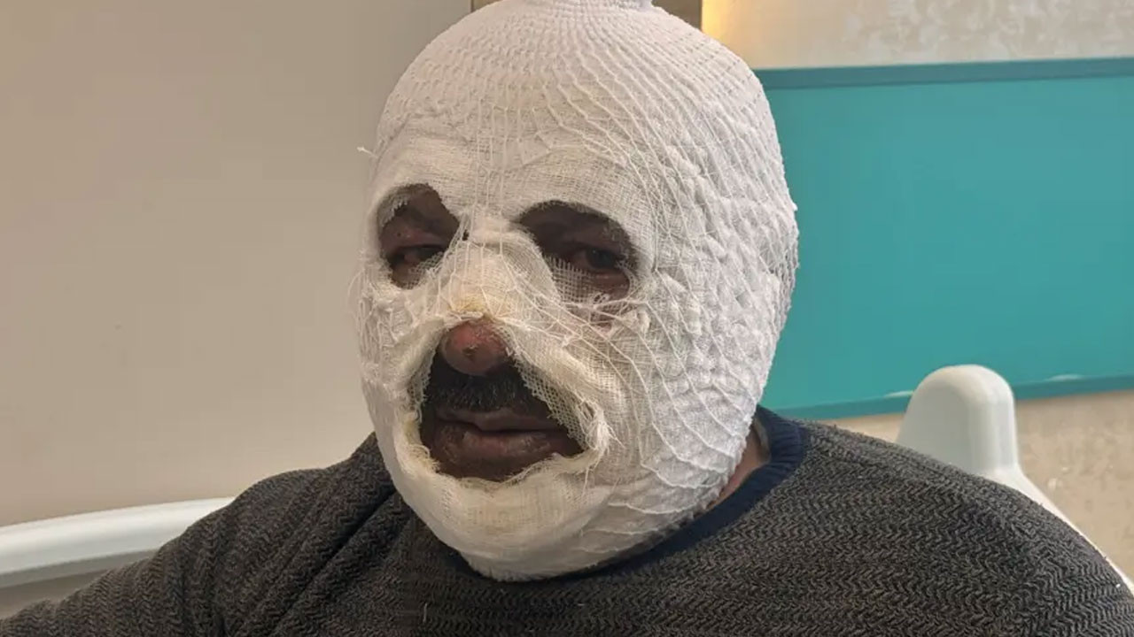 Kaloriferi yakmak isterken yandı! ''Mümkün olduğunca böyle bir hata yapmasınlar''