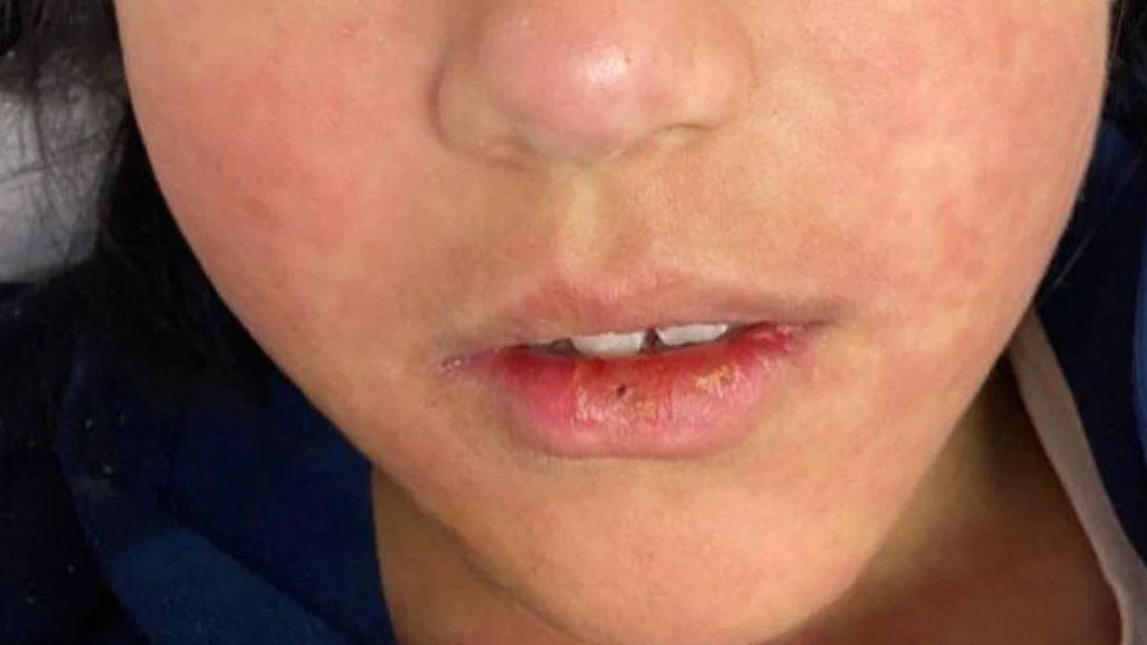 Hastalık yayılıyor, 6 haftada 227 çocuk hayatını kaybetti