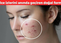 Yazın oluşan kistik sivilceleri kökünden kurutuyor: Meğer tek yapmanız gereken buymuş!