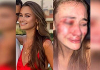 Çeşme'de tatil yapan Ukraynalı mankenin 'darp' iddiasına polisten soruşturma