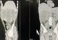 Halsizlik şikayetiyle gitti, karnından 20 santimlik kitle çıkarıldı