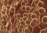 Gizemli hepatit virüsünde küresel salgın şüphesi