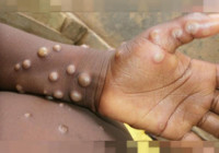 Korkunç hastalık yayılıyor! Dünyanın yeni kabusu olabilir