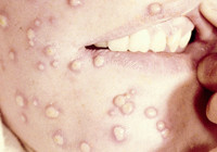 Maymun çiçeği virüsü bir ülkeye daha sıçradı