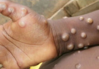 Kabus büyüyor! AB üyesi 8 ülke 'maymun çiçeği virüsü' ile savaşıyor