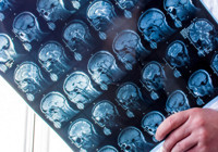 MS hastalığında yeni tedavi umudu