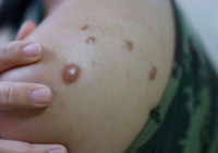 Sağlık Bakanlığı 'maymun çiçeği virüsü' için rehber yayınladı