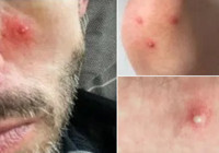 DSÖ’den maymun çiçeği uyarısı: Risk grubundaki erkekler cinsel partnerlerinin sayısını sınırlamalı