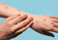 Almanya’da 2 bin 724 maymun çiçeği vakası görüldü