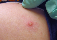 Prof. Dr. Gürüz'den dikkat çeken açıklama: Maymun çiçeğine karşı yüzde 85 koruyor