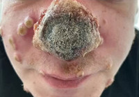 Maymun çiçeğinde korkunç görüntü: 3 gün içerisinde burnu çürüdü