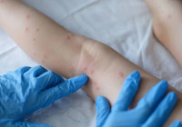 Yeni salgın alarmı: Domates gribi! Belirtileri neler, bulaşıcı mı?