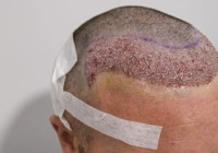 Uzman ellerde saç ekimi teknikleri