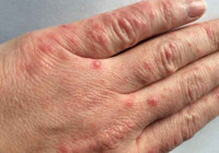 Uyuz vakalarında artış!