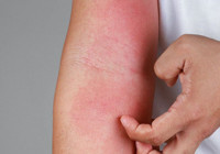 Uyuz belirtileri nelerdir, tedavisi nasıl olur? Uyuzun bittiğini nasıl anlarız?