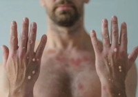 Avrupa'da maymun çiçeği vakalarının sayısı 24 bini geçti