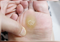 Ayaktaki nasır sizi böbrek yetmezliğine götürebilir