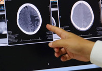 Çocuklardaki beyin tümörünün tedavisinde umut veren gelişme