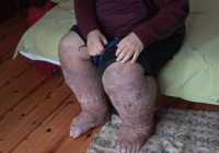 Sivrisinek ısırığı hayatını kararttı