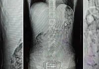 Polis şüphelenip durdurdu, midesinden ve bağırsaklarından uyuşturucu çıktı