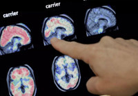 Demans hastalığı için yeni umut ışığı! 12 yıl önceye kadar tespiti mümkün