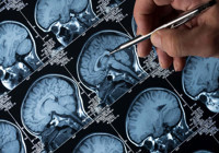 İki kanser ilacı çare olabilir! Alzheimer tedavisinde yeni umut