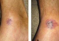 Türkiye'de et yiyen bakteri vakası görüldü mü? Bakanlıktan açıklama