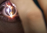 Göz tedavisinde lazersiz yöntem umut veriyor