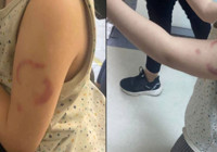 Kreşte akıl almaz olay: Öğrencisini ısıran öğretmen tutuklandı