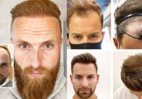 Saç ekimi sonuçlarında başarıyı belirleyen 5 kritik nokta