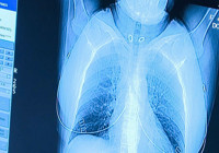 Türkiye'de her yıl 45 bin yeni vaka! Bu illere dikkat: Risk daha fazla!