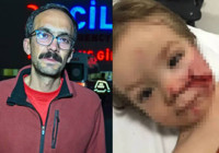 Başkentte pitbull dehşeti! İki kardeş yaralandı, birinin yüzü parçalandı