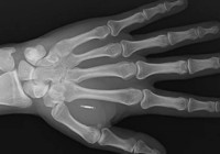 Vücuduna yerleştirdiği çipin şifresini unuttu