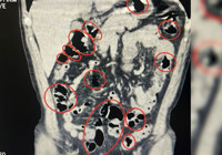 Yabancı uyruklu 2 kişinin mide ve bağırsaklarından uyuşturucu çıktı