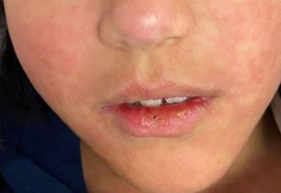 Hastalık yayılıyor, 6 haftada 227 çocuk hayatını kaybetti