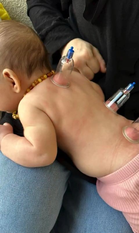 Küçücük bebeklere hacamat yaptırıyorlar! Aman dikkat: Büyük bir riski var - Resim: 3