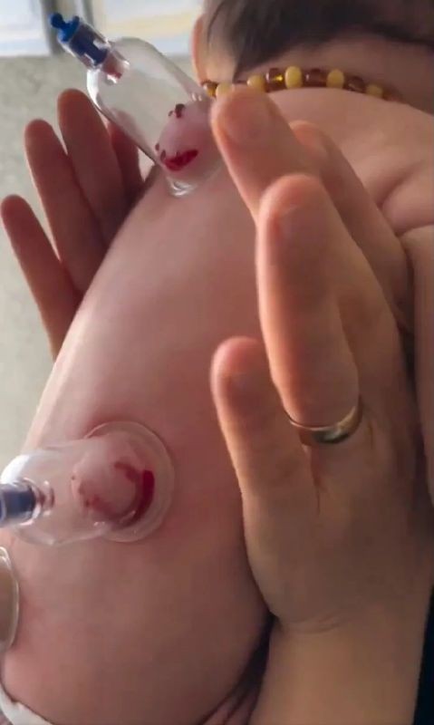 Küçücük bebeklere hacamat yaptırıyorlar! Aman dikkat: Büyük bir riski var - Resim: 4