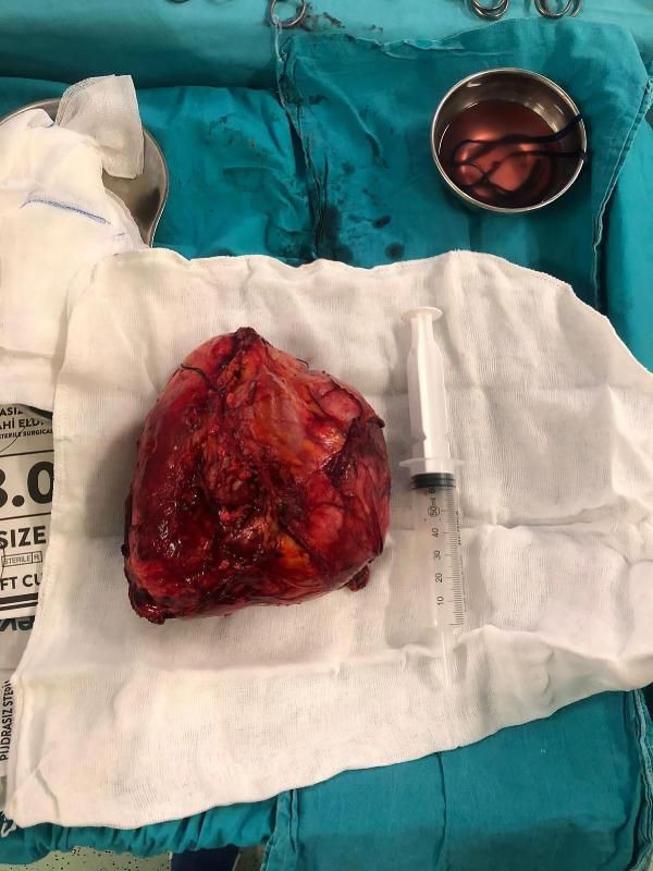 Halsizlik şikayetiyle gitti, karnından 20 santimlik kitle çıkarıldı - Resim: 4