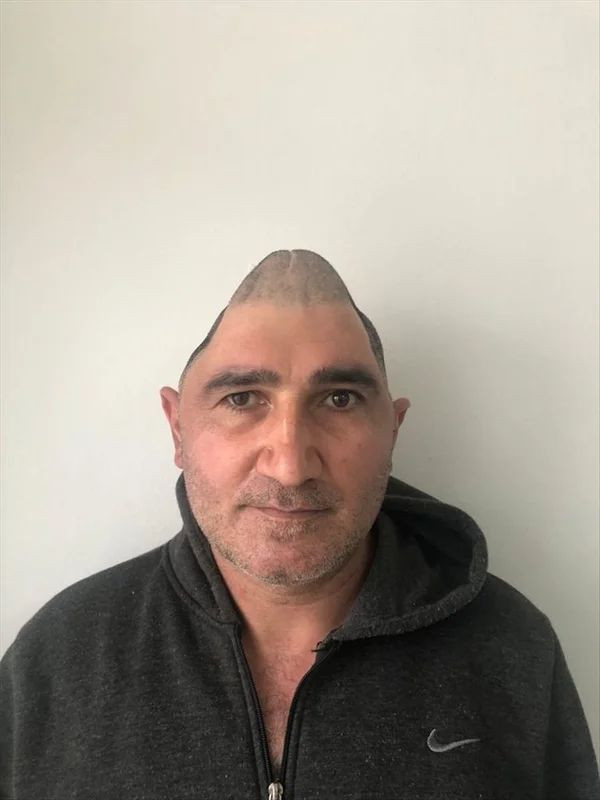 Kafatasının yüzde 83'ü parçalanmıştı! Titanyum parçalarıyla eski görüntüsüne kavuştu - Resim: 2