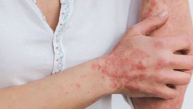 Uyuz belirtileri nelerdir, tedavisi nasıl olur? Uyuzun bittiğini nasıl anlarız? - Resim : 1