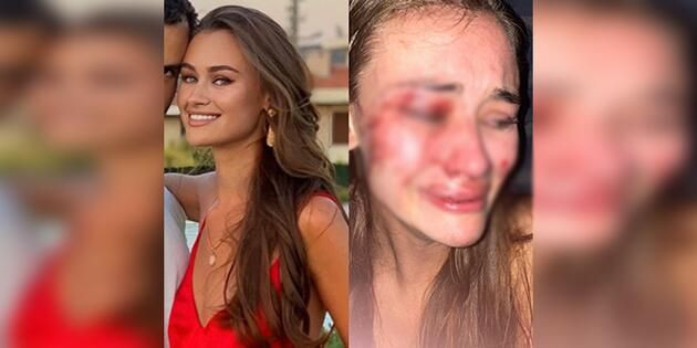 Çeşme'de tatil yapan Ukraynalı mankenin 'darp' iddiasına polisten soruşturma - Resim: 1