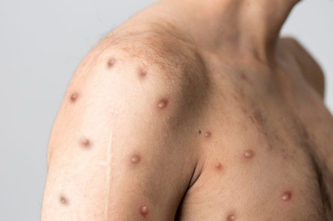 Sağlık Bakanlığı 'maymun çiçeği virüsü' için rehber yayınladı - Resim: 2