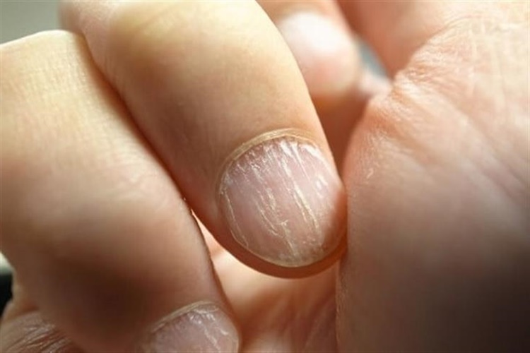 Tırnaklarınıza iyi bakın! O hastalığın habercisi olabilir - Resim: 4