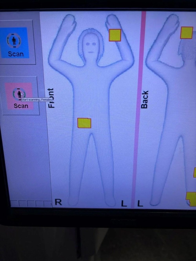 X-ray'de çıkmadı: Röntgene gönderdiler... Cinsel organlarından 6 kilo altın çıktı - Resim: 4
