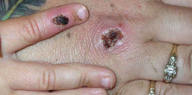 Kabus büyüyor! AB üyesi 8 ülke 'maymun çiçeği virüsü' ile savaşıyor - Resim: 2