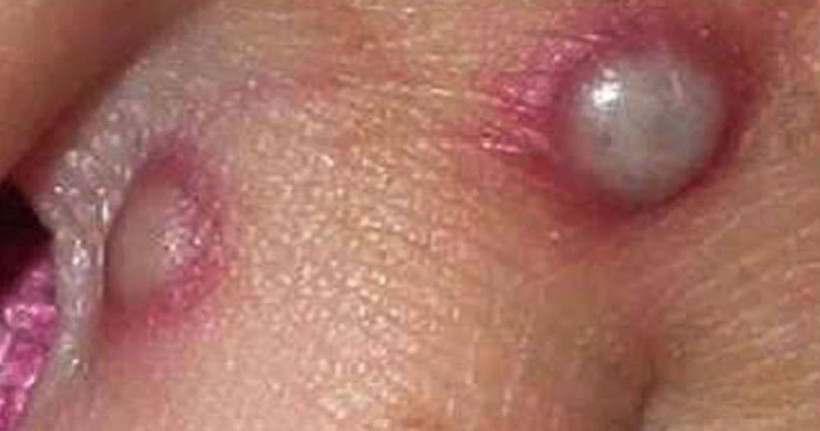 Kabus büyüyor! AB üyesi 8 ülke 'maymun çiçeği virüsü' ile savaşıyor - Resim: 3