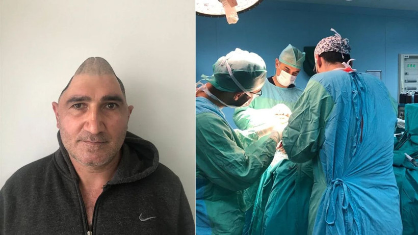 Kafatasının yüzde 83'ü parçalanmıştı! Titanyum parçalarıyla eski görüntüsüne kavuştu - Resim: 1