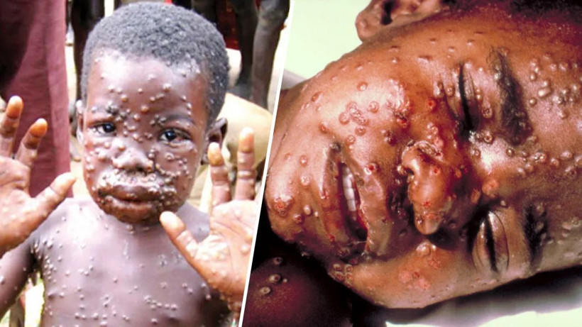 Maymun çiçeği virüsü bir ülkeye daha sıçradı - Resim: 4